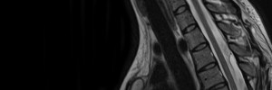 MRI Gallery - Paediatric MRI Series - MRI Spine