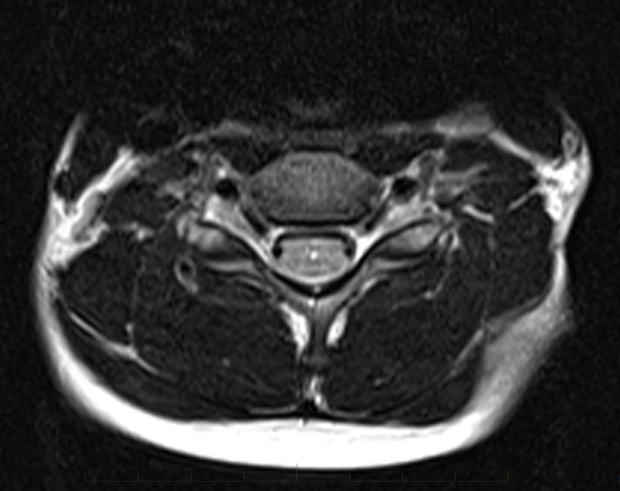 Axial images through the cervical spine in a paediatric patient demonstrates a tiny central hyperintense (briht) focus of the central spinal cord, known as a syrinx