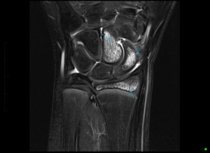 Paediatric MRI of the Wrist - bone bruises are seen of the capitate, scaphoid and the distal radius.
