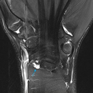 Paediatric MRI Wrist - ganglion cyst formation, which occurs when increased fluid in the joint leads to excessive pressure and herniation of fluid from the confines of the joint.