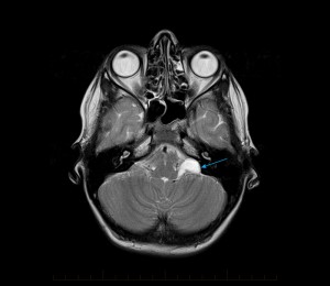 MRI of a Child's Brain - demonstrates the presence of a left sided benign arachnoid cyst (arrow) located at the cerebellopontine angle.