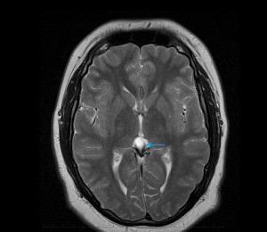 MRI of Paediatric Brain - demonstrates presence of a benign simple cyst of the pineal gland (arrow)