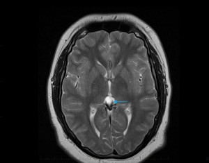 MRI of the brain of a child demonstrates the presence of a benign simple cyst of the pineal gland (arrow).