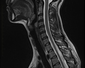 Paediatric MRI Spine