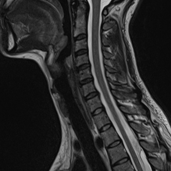 Paediatric MRI Spine
