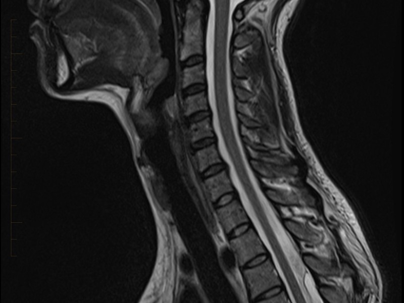 Paediatric MRI Spine