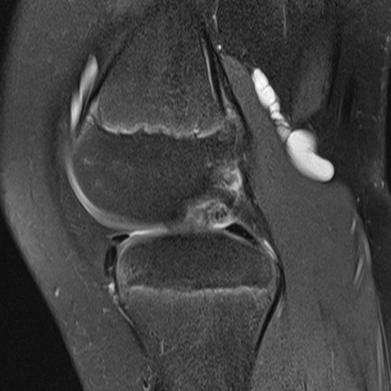 Paediatric MRI of Knee - Bakers Cyst
