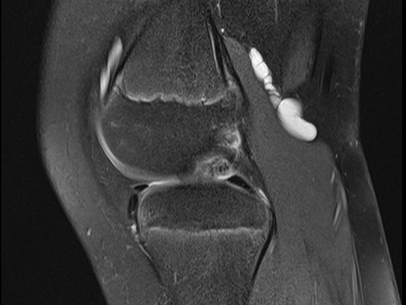 Paediatric MRI of Knee - Bakers Cyst