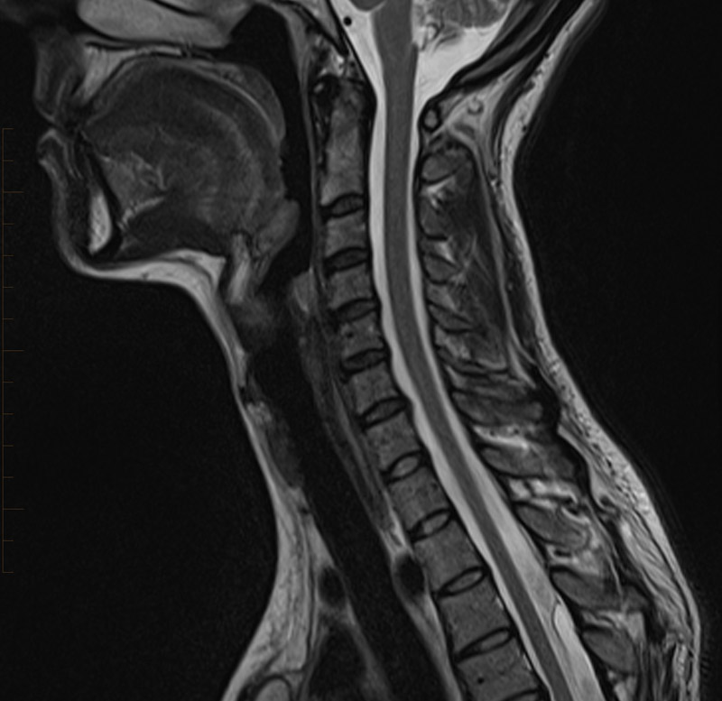 MRI Scan of Cervical Spine in a Paediatric Patient