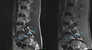 MRI assessment of the spine to assess for the presence ofspondylolysis, also known as a pars interarticularis fracture/defect