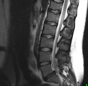 MRI assessment of child with right sided sciatica