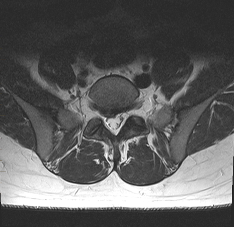 MRI assessment of child with right sided sciatica, axial image