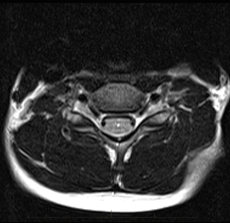 MRI Spine - Axial images in patient paediatric patient showing hyperintense (bright) focus of the central spinal cord, known as a syrinx