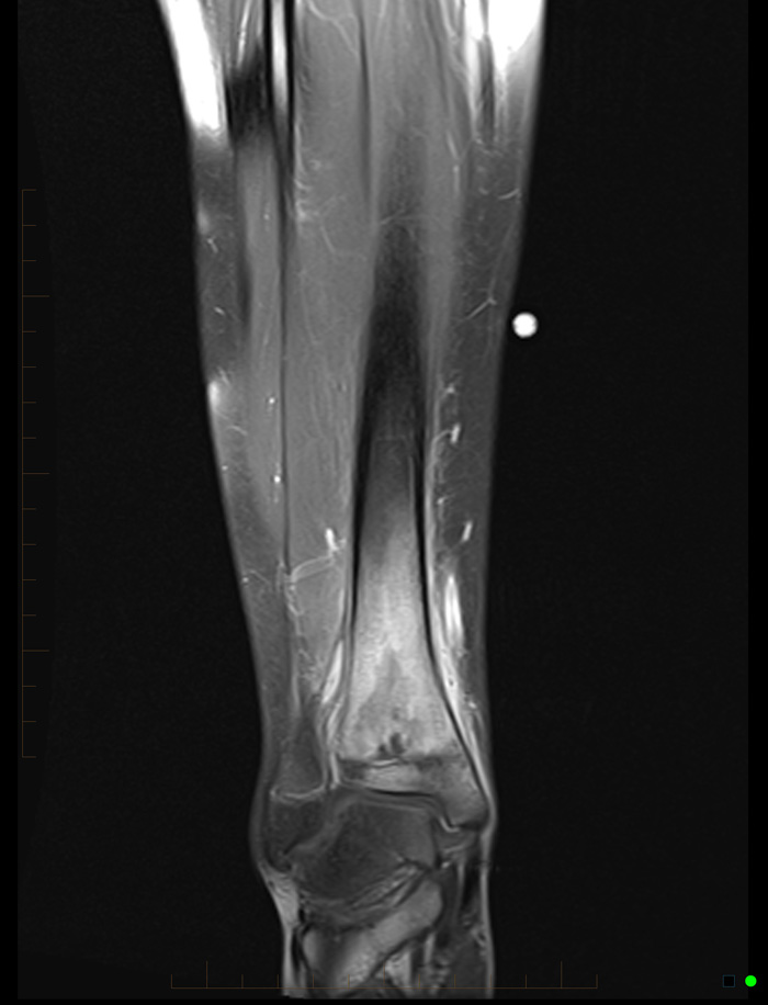 melbourne-radiology-mri-bone-marrow-oedema-postcontrast