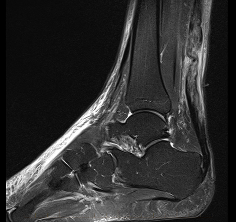 melbournemrileftachillestendonrupture7 MRI at Melbourne