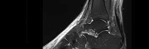 MRI Series - Achilles tendon - Melbourne Radiology Clinic