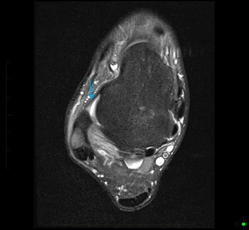 MRI of Foot and Ankle - normal anterior talofibular ligament
