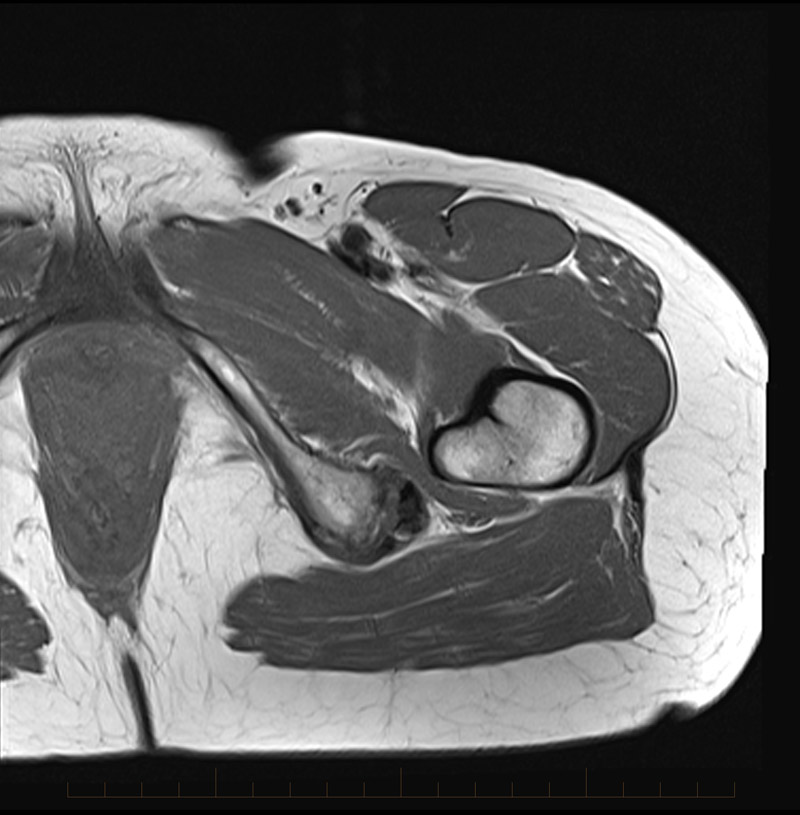MRI Hamstring bursitis