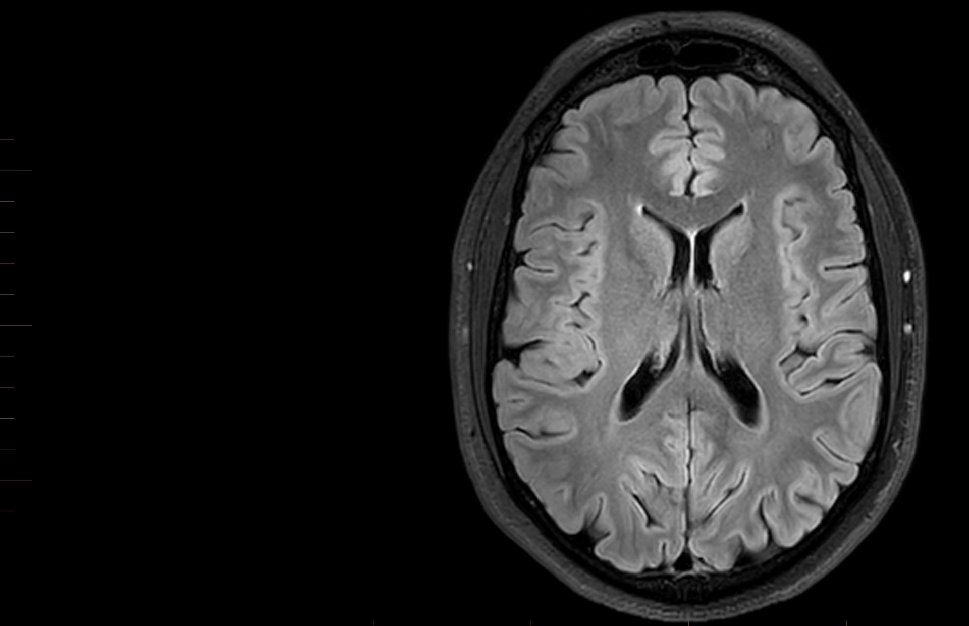Adult MRI