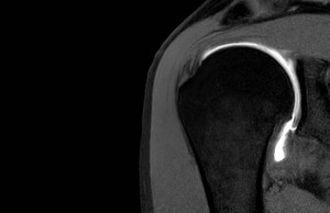 Shoulder MRI Scan - Musculoskeletal Imaging at Melbourne Radiology Clinic