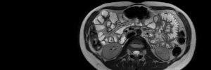 Small Bowel MRI to evaluate Crohn's Disease